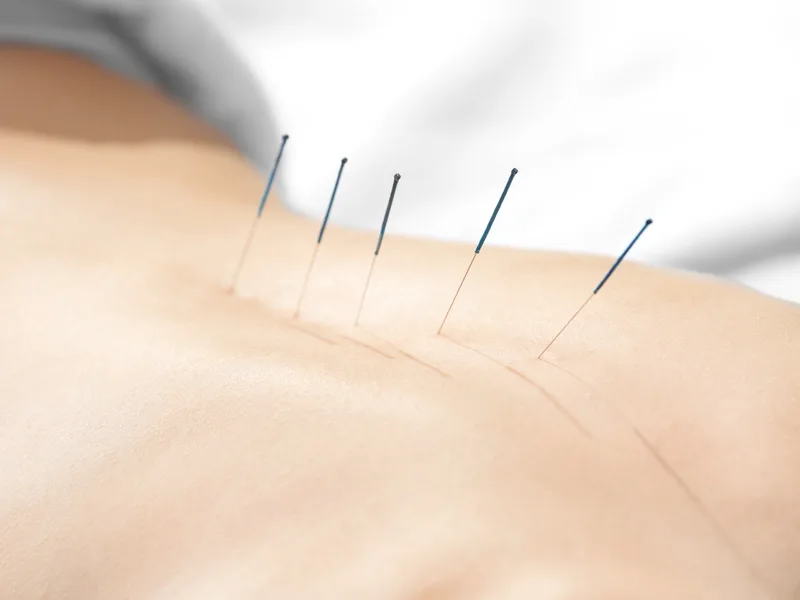 Acupuncture at The Lab Chiropractic in Charles