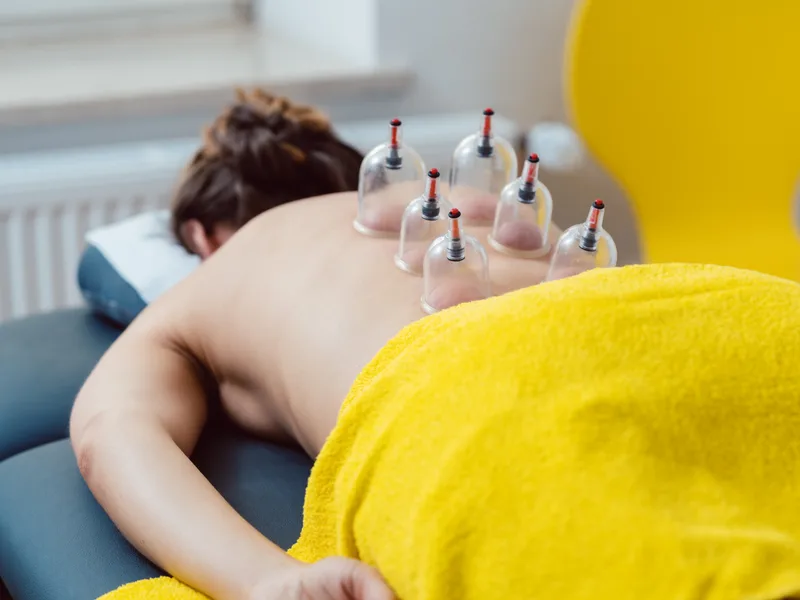 Cupping Therapy at The Lab Chiropractic in Charles