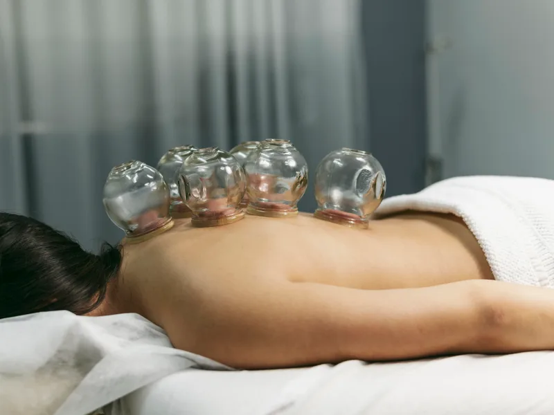 Cupping Therapy at The Lab Chiropractic in Charles