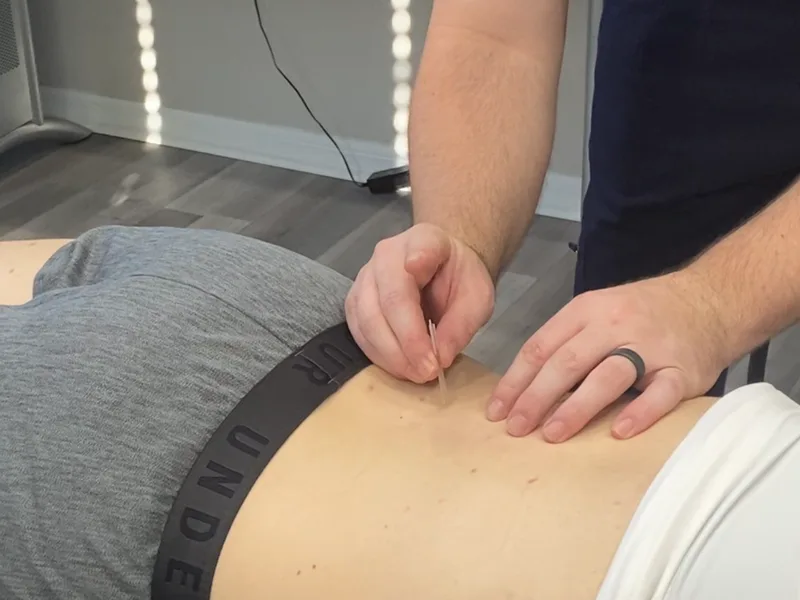 How Dry Needling works at The Lab Chiropractic