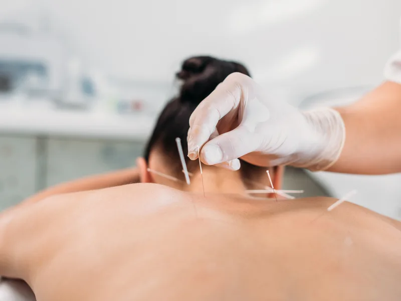 Dry Needling at The Lab Chiropractic in Charles